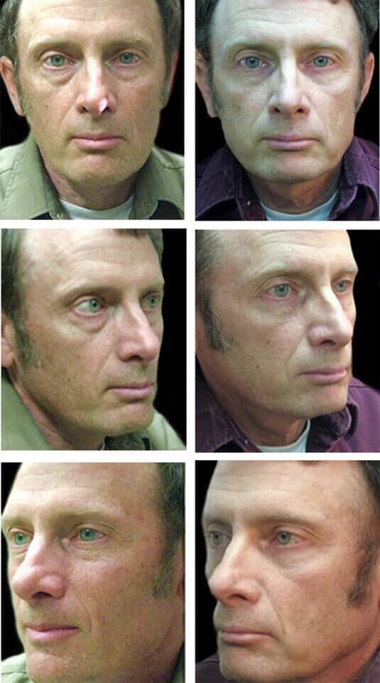  Before and After Picture 
54 Year Old Male - Lower Blepharoplasty