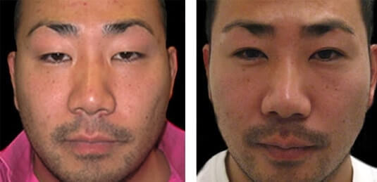  Before and After Picture 
32 Year Old Male - Upper Blepharoplasty