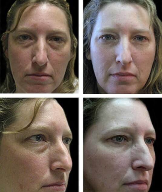  Before and After Picture 
41 Year Old Female - Lower Blepharoplasty