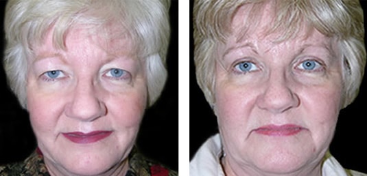  Before and After Picture 
55 Year Old Female - Upper Blepharoplasty