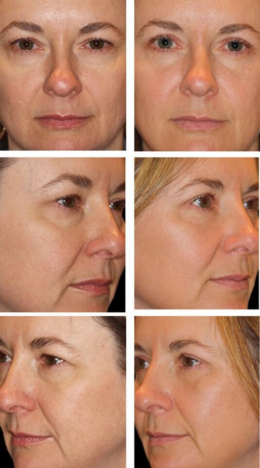  Before and After Picture 
45 Year Old Female - Upper and Lower Blepharoplasty