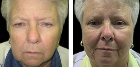  Before and After Picture 
61 Year Old Female - Upper Blepharoplasty