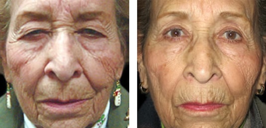  Before and After Picture 
83 Year Old Female - Upper Blepharoplasty