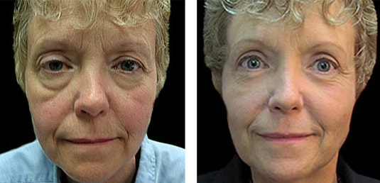  Before and After Picture 
58 Year Old Female - Upper and Lower Blepharoplasty with Laser Resurfacing