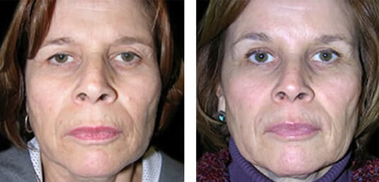  Before and After Picture 
60 Year Old Female - Upper Blepharoplasty and Endoscopic Brow Lift (Forehead Lift)