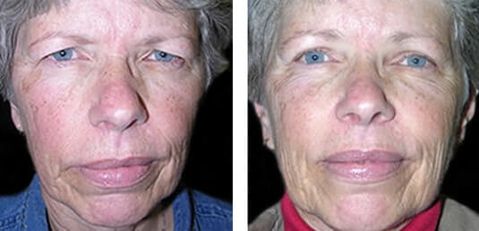  Before and After Picture 
58 Year Old Female - Upper Blepharoplasty and Endoscopic Brow Lift (Forehead Lift)