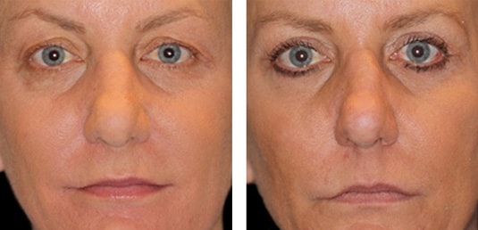  Before and After Picture 
62 year old female - Bilateral upper and lower lid fractional, CO2 laser skin resurfacing, Bilateral upper lid blepharoplasty
