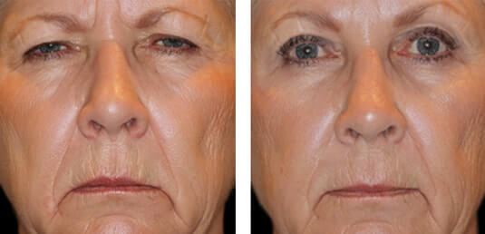  Before and After Picture 
67 year old female - Full face fractional CO2 laser skin resurfacing, Bilateral endoscopic brow lift, Bilateral upper and lower lid blepharoplasty