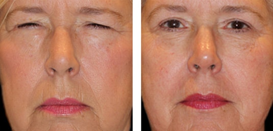  Before and After Picture 
67 year old female - Full face fractional CO2 laser skin resurfacing, Bilateral upper and lower lid blepharoplasty