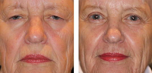  Before and After Picture 
71 year old female - Full face fractional CO2 laser skin resurfacing, Bilateral upper lid blepharoplasty, Left brow lift