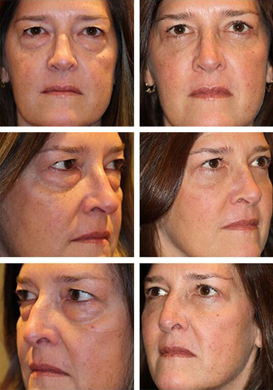  Before and After Picture 
53 Year Old Female - Lower Blepharoplasty