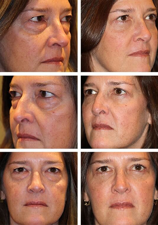  Before and After Picture 
53 Year Old Female - Lower Blepharoplasty