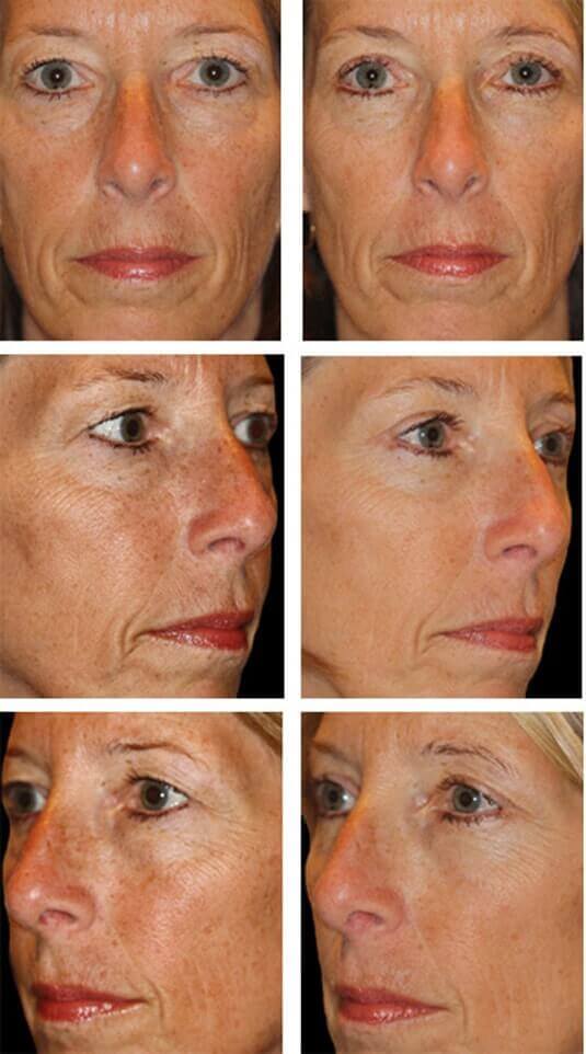  Before and After Picture 
53 Year Old Female - Upper and Lower Blepharoplasty