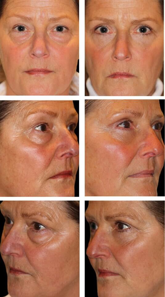  Before and After Picture 
56 Year Old Female - Upper and Lower Blepharoplasty