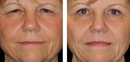  Before and After Picture 
62 Year Old Female - Full Face Fractional CO2 Laser Skin Resurfacing, Bilateral Upper Lid Blepharoplasty