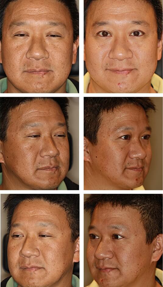  Before and After Picture 
48 Year Old Male Upper Blepharoplasty and Bilateral Upper Lid Ptosis Repair