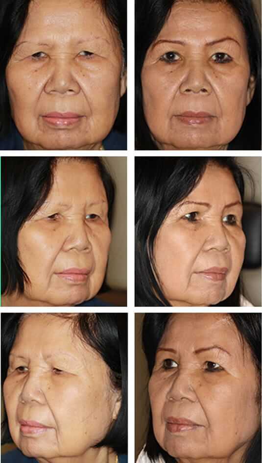  Before and After Picture 
67 Year Old Female Upper Blepharoplasty