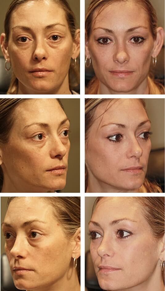  Before and After Picture 
41 Year Old Female - Lower Blepharoplasty with Periocular Laser Skin Resurfacing