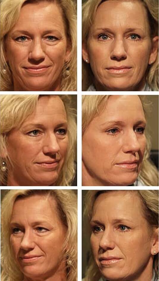  Before and After Picture 
45 Year Old Female - Upper and Lower Bleph with Periocular Laser Skin Resurfacing