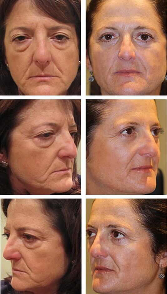  Before and After Picture 
53 Year Old Female Upper and Lower Blepharoplasty