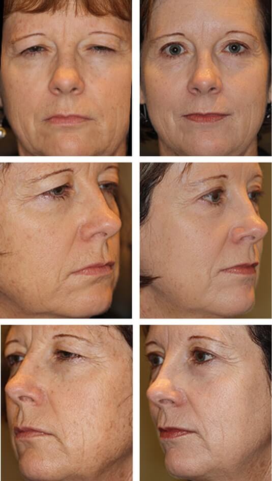  Before and After Picture 
53 Year Old Female - Brow Lift, Upper Blepharoplasty Full Face Laser Skin Resurfacing