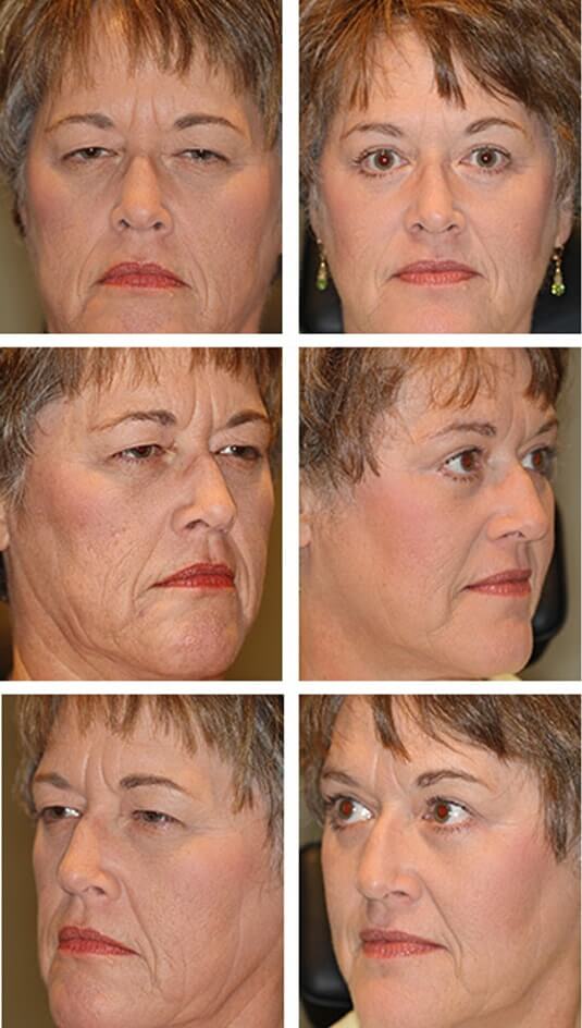  Before and After Picture 
52 Year Old Female - Upper and Lower Blepharoplasty