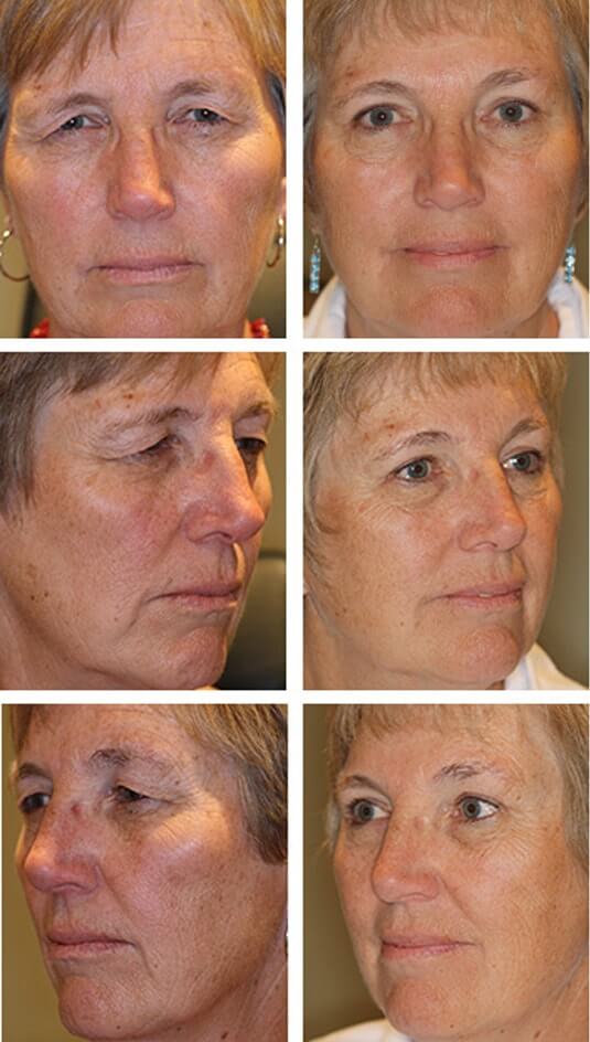  Before and After Picture 
61 Year Old Female Upper - Blepharoplasty and Brow Lift