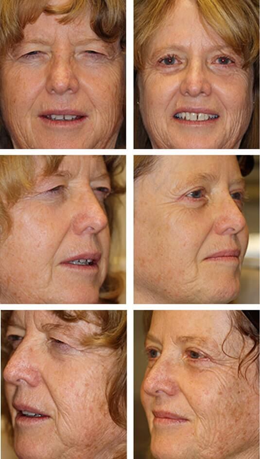  Before and After Picture 
59 Year Old Female - Upper and Lower Blepharoplasty and Brow Lift