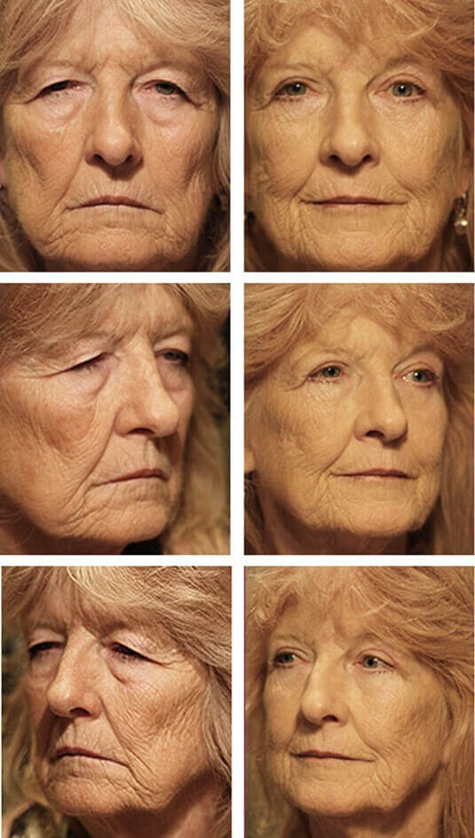  Before and After Picture 
73 Year Old Female - Upper and Lower Blepharoplasty