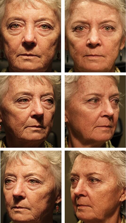  Before and After Picture 
65 Year Old Female - Upper and Lower Blepharoplasty