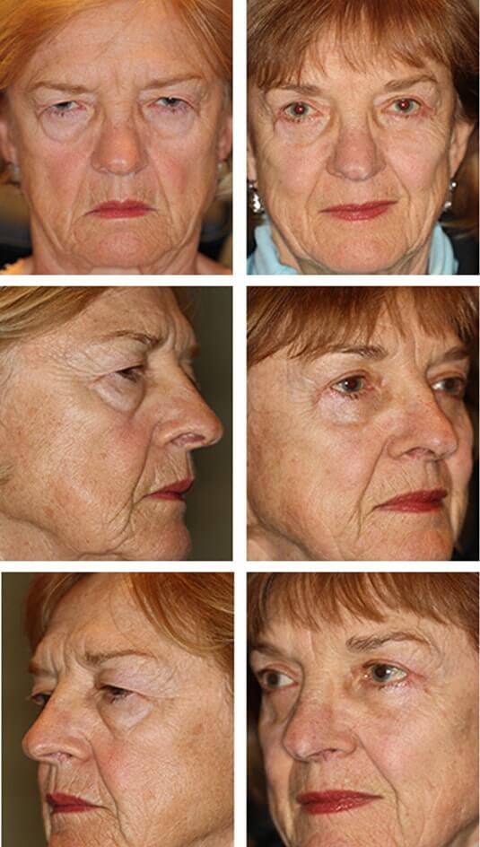  Before and After Picture 
71 Year Old Female Female - Upper and Lower Blepharoplasty