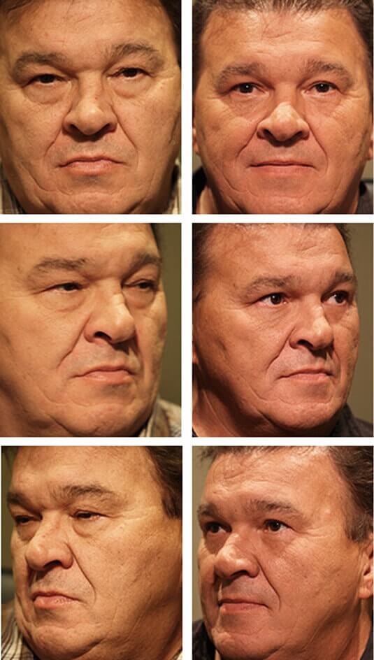  Before and After Picture 
56 Year Old - Male Upper and Lower Blepharoplasty