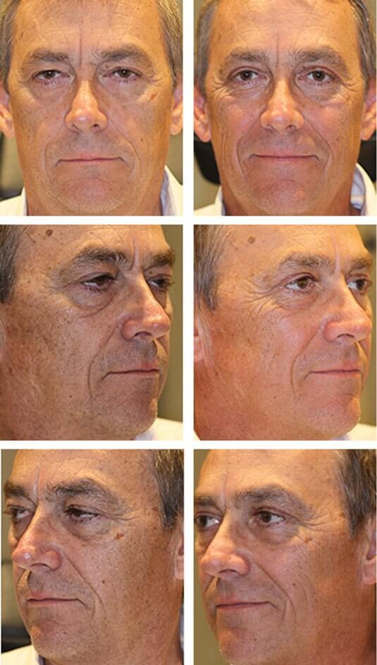  Before and After Picture 
56 Year Old Male - Upper Blepharoplasty