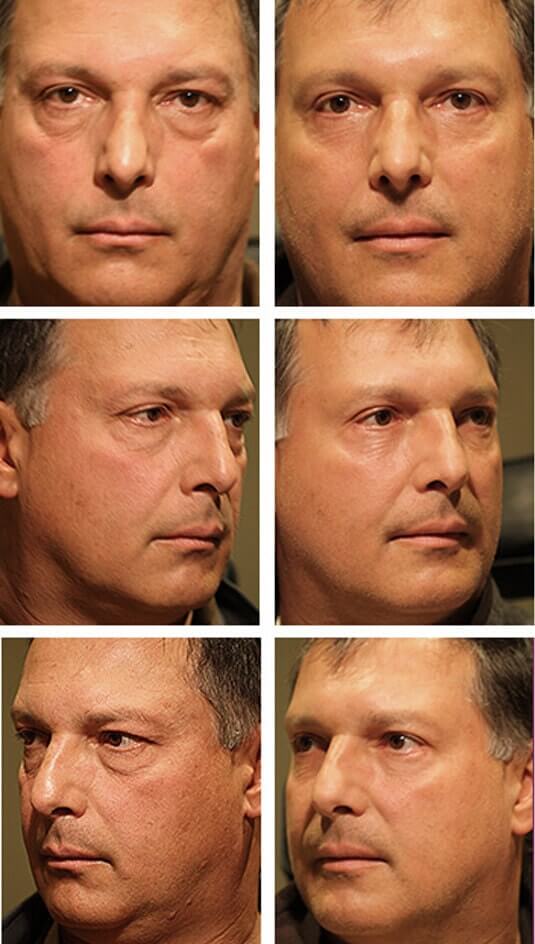  Before and After Picture 
53 Year Old Male - Upper and Lower Blepharoplasty
