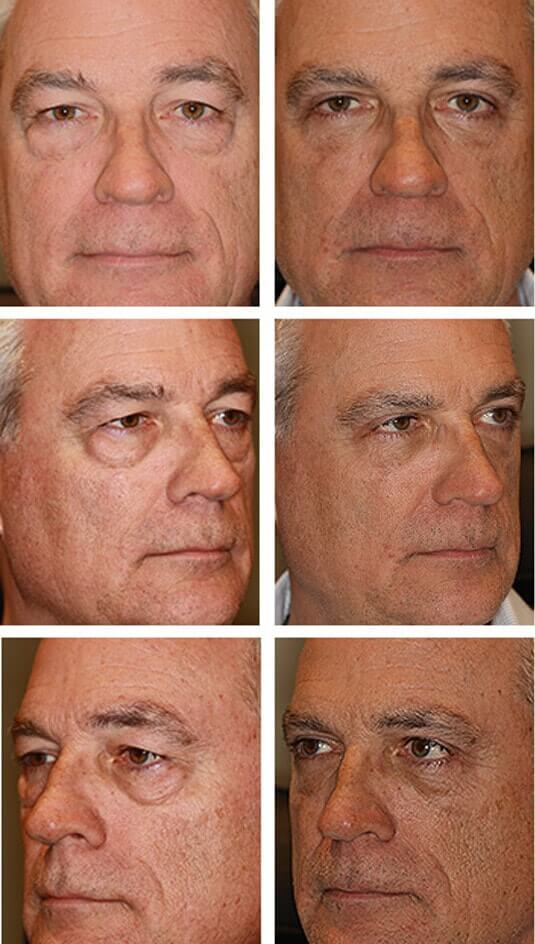  Before and After Picture 
59 Year Old - Male Upper and Lower Blepharoplasty