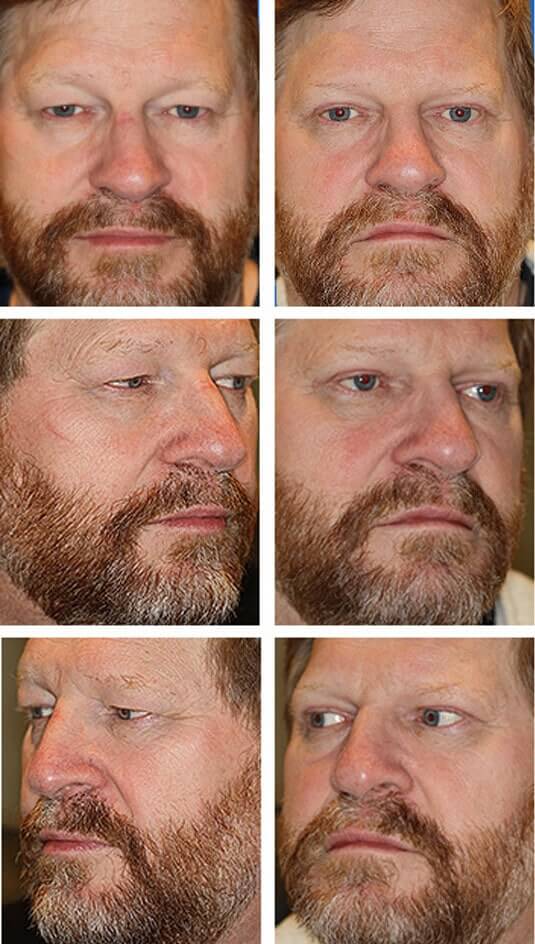  Before and After Picture 
54 Year Old Male - Upper Blepharoplasty with Brow Pexy