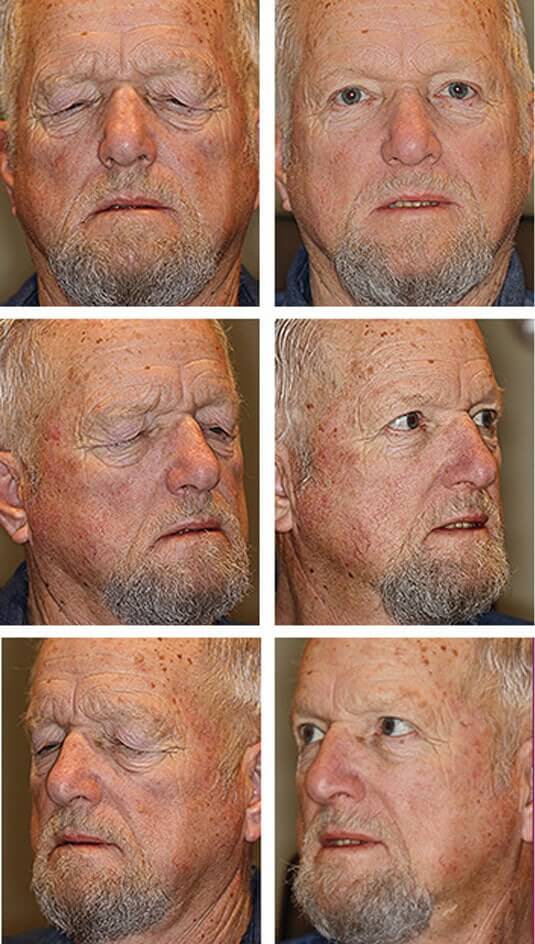  Before and After Picture 
70 Year Old Male - Upper Blepharoplasty and Brow Lift