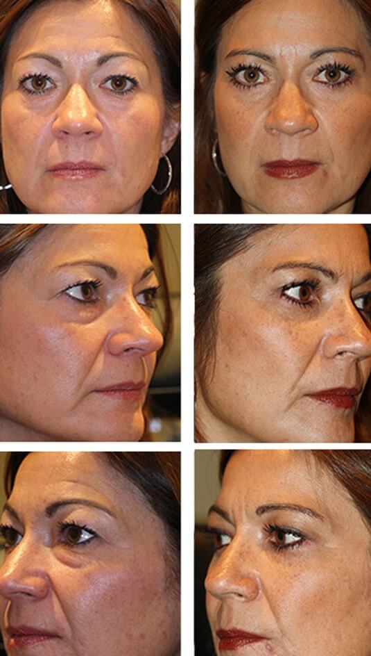  Before and After Picture 
47 Year Old Female – Upper and Lower Blepharoplasty