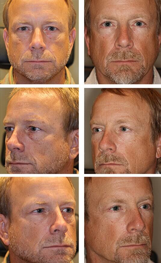  Before and After Picture 
57 year old male – upper and lower Blepharoplasty