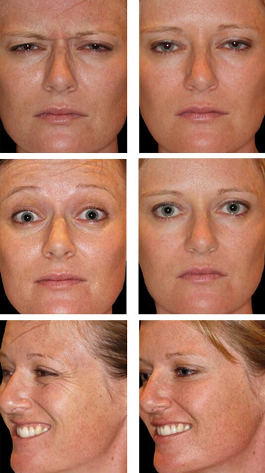  Before and After Picture  
36 Year Old Female - Botulinum Toxin to Frown Lines, Forehead and Crow's Feet