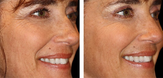  Before and After Picture  
52 Year Old Female - Dysport® to Crow's Feet