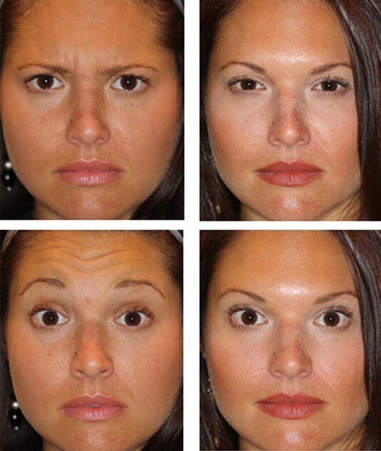  Before and After Picture  
28 Year Old Female - Botulinum Toxin to frown lines and forehead