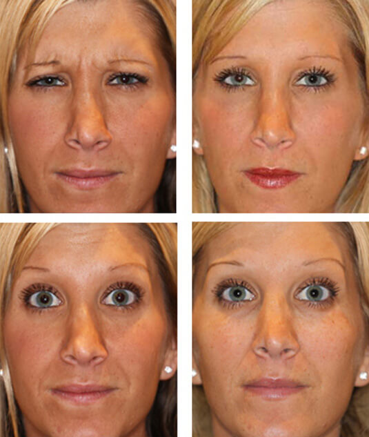  Before and After Picture  
31 Year Old Female - Dysport® to Frown Lines and forehead