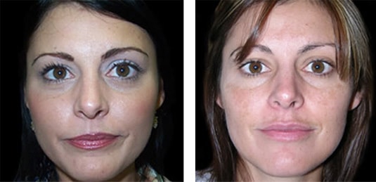  Before and After Picture  
30 Year Old Female - Botulinum Toxin, Right Brow Lift (Forehead Lift)