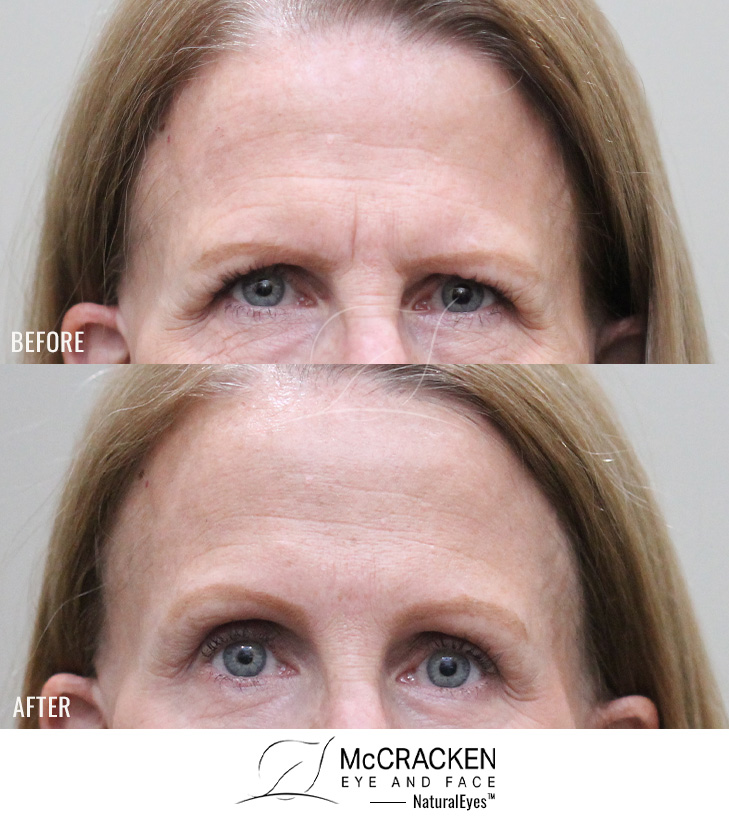 59 Year Old Female Endoscopic Brow Lift, Lower Lid Blepharoplasty with Fat Repositioning, and Periocular Laser Skin Resurfacing. The brow lift was fixated with EndoTines. No Lower Lid Skin Incisions Were Made.