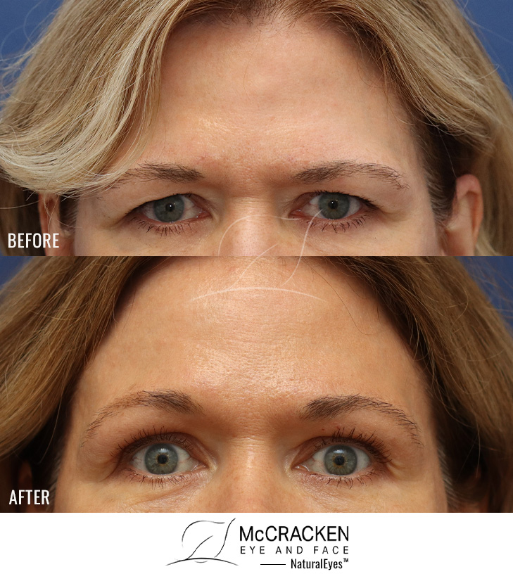52 Year Old Female Endoscopic Brow Lift with Upper Blepharoplasty and Shaving of Bone Spur (Osteoma) in the Central Forehead. The brow lift was fixated with EndoTines.