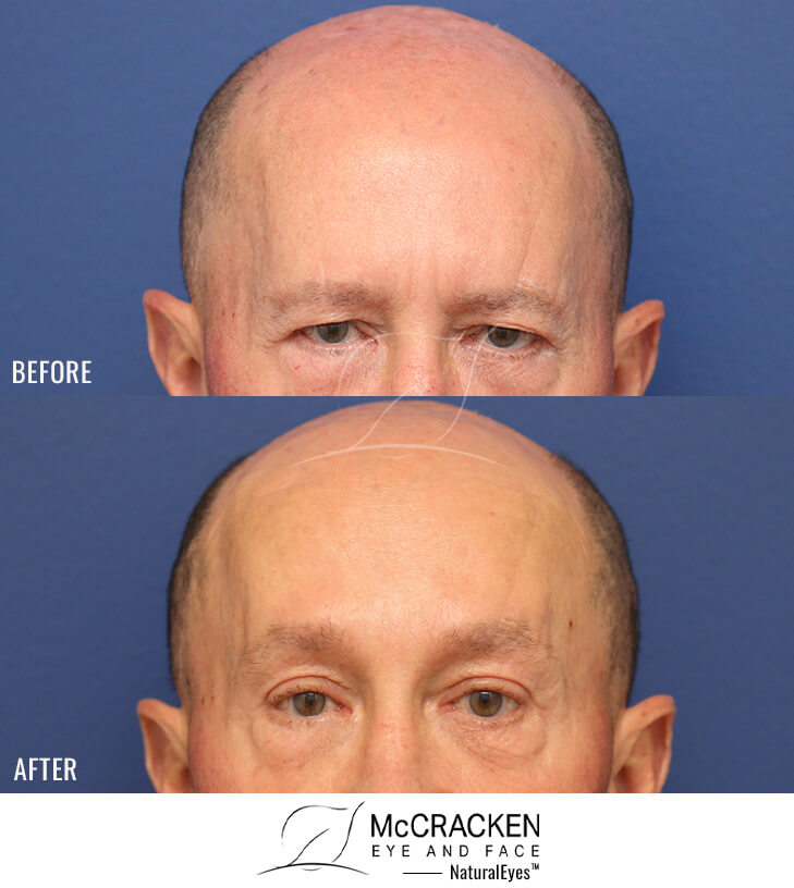 72 Year Old Male Upper Blepharoplasty and Endoscopic Brow Lift with Endotine fixation.