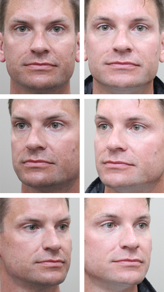  Before and After Picture  
42 Year Old Male – Brow Lift.  This patient desired elevation of the central brow.  He underwent a central endoscopic brow lift with Endotine fixation.
