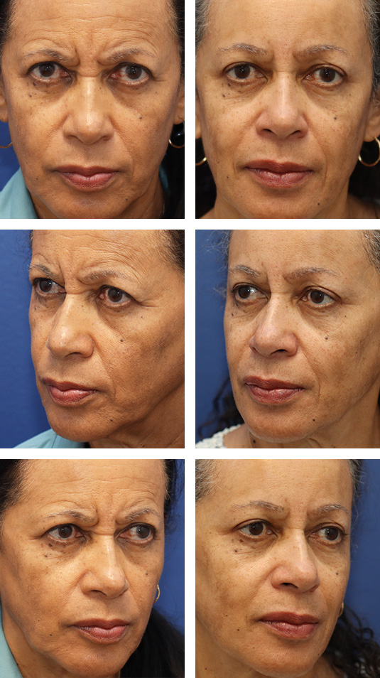  Before and After Picture 
70 Year Old Female – Endoscopic Brow Lift fixated with EndoTines.