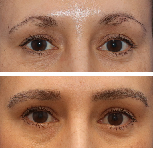  Before and After Picture 
43 year old female, 6 months after one hair transplant to brows.